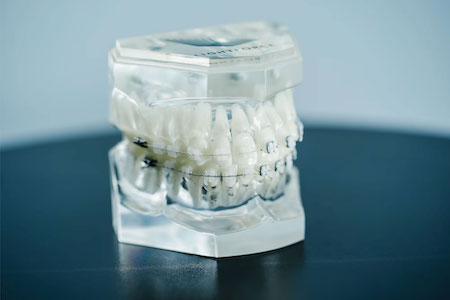 Lightforce Model on teeth